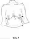 Fig. 04 - Breast support apparatus
