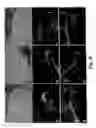 Fig. 05 - Inhibition of invasive remodelling