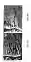 Fig. 11 - Medical uses of a selective estrogen receptor modulator in combination with sex steroid precursors