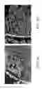 Fig. 12 - Medical uses of a selective estrogen receptor modulator in combination with sex steroid precursors