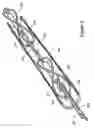 Fig. 09 - Tissue shaping device with self-expanding anchors