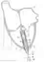 Fig. 01 - Device for covering a tissue region on a wall of a heart