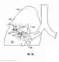 Fig. 03 - Devices for maintaining surgically created openings