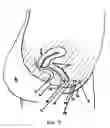 Fig. 05 - Bodily exudate capturing article