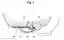 Fig. 03 - Interlabial pad