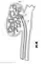 Fig. 06 - Activatable bioactive implantable medical device and method of use