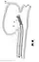 Fig. 05 - Activatable bioactive implantable medical device and method of use