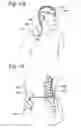 Fig. 02 - Catheters with tracking elements and permeable membranes