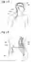 Fig. 02 - Permeable membrane catheters, systems, and methods