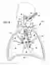 Fig. 05 - Apparatus and method for resecting and removing selected body tissue from a site inside a patient