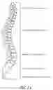 Fig. 02 - Guide pin for guiding instrumentation along a soft tissue tract to a point on the spine