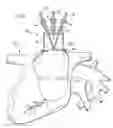 Fig. 09 - Universal cardiac introducer