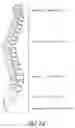 Fig. 02 - Method of spinal fixation