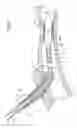 Fig. 05 - Balloon catheter retrieval device
