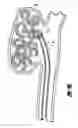 Fig. 06 - Activatable foam expandable implantable medical device and method of use