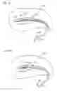 Fig. 34 - Method of intravascularly delivering stimulation leads into brain