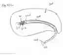 Fig. 40 - Method of intravascularly delivering stimulation leads into brain