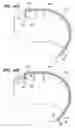 Fig. 09 - Method of intravascularly delivering stimulation leads into direct contact with tissue