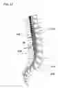 Fig. 06 - Method for applying pulsed radio frequency energy to the spinal canal