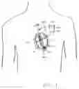 Fig. 02 - Endocardial lead for a left heart chamber