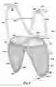 Fig. 07 - Methods for venous valve replacement with a catheter