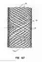 Fig. 10 - Methods and apparatus for endovascularly replacing a patient's heart valve