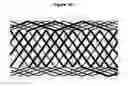 Fig. 17 - Methods and apparatus for endovascularly replacing a patient's heart valve