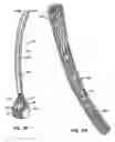 Fig. 03 - Methods and apparatus for endovascularly replacing a patient's heart valve