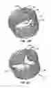 Fig. 04 - Methods and apparatus for endovascularly replacing a patient's heart valve