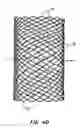 Fig. 10 - Methods and apparatus for endovascularly replacing a patient's heart valve