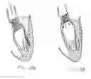 Fig. 22 - Methods and apparatus for endovascularly replacing a patient's heart valve
