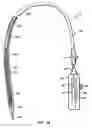 Fig. 02 - Methods and apparatus for endovascularly replacing a patient's heart valve