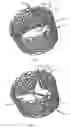 Fig. 04 - Methods and apparatus for endovascularly replacing a heart valve