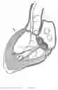 Fig. 06 - Methods and apparatus for endovascularly replacing a heart valve