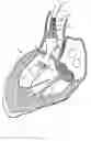 Fig. 08 - Methods and apparatus for endovascularly replacing a heart valve