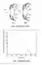 Fig. 02 - Accommodative intraocular lens
