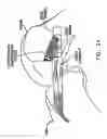 Fig. 28 - Method and apparatus for reconstructing a ligament