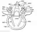 Fig. 01 - Facet arthroplasty devices and methods