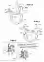 Fig. 04 - Facet arthroplasty devices and methods