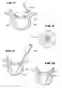 Fig. 05 - Facet arthroplasty devices and methods
