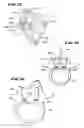 Fig. 07 - Facet arthroplasty devices and methods