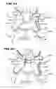 Fig. 11 - Facet arthroplasty devices and methods