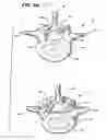 Fig. 13 - Facet arthroplasty devices and methods