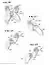 Fig. 17 - Facet arthroplasty devices and methods