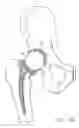 Fig. 08 - One piece snap fit acetabular cup