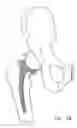 Fig. 09 - One piece snap fit acetabular cup