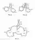 Fig. 02 - Methods and devices for maintaining patency of surgically created channels in a body organ