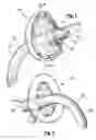 Fig. 02 - Method and apparatus for ventilation / oxygenation during guided insertion of an endotracheal tube
