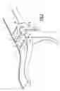 Fig. 06 - Structural element for a motor vehicle comprising two metal members and a reinforcing piece of plastics material which brings about the connection of the members, and a corresponding motor vehicle