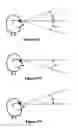 Fig. 49 - Electro-active multi-focal spectacle lens